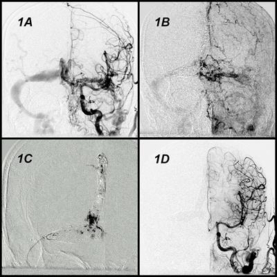 Grouting technique—combining transvenous Onyx and coils for the embolization of complex non-cavernous intracranial dural arteriovenous fistulas